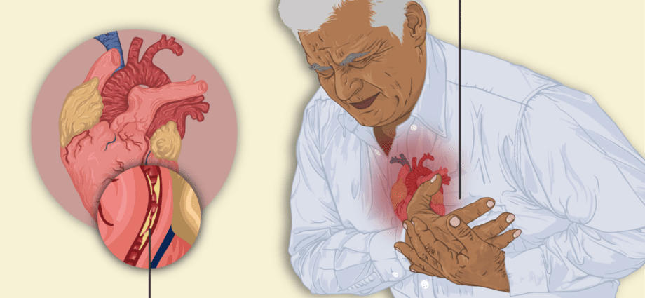 Heart attack and angina pectoris: the first steps