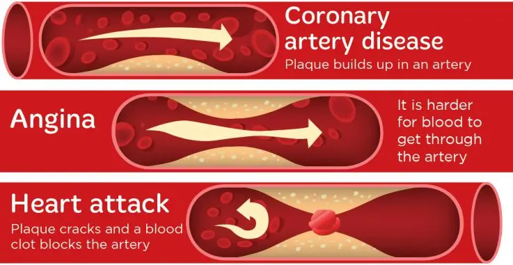 Angina: what is it?