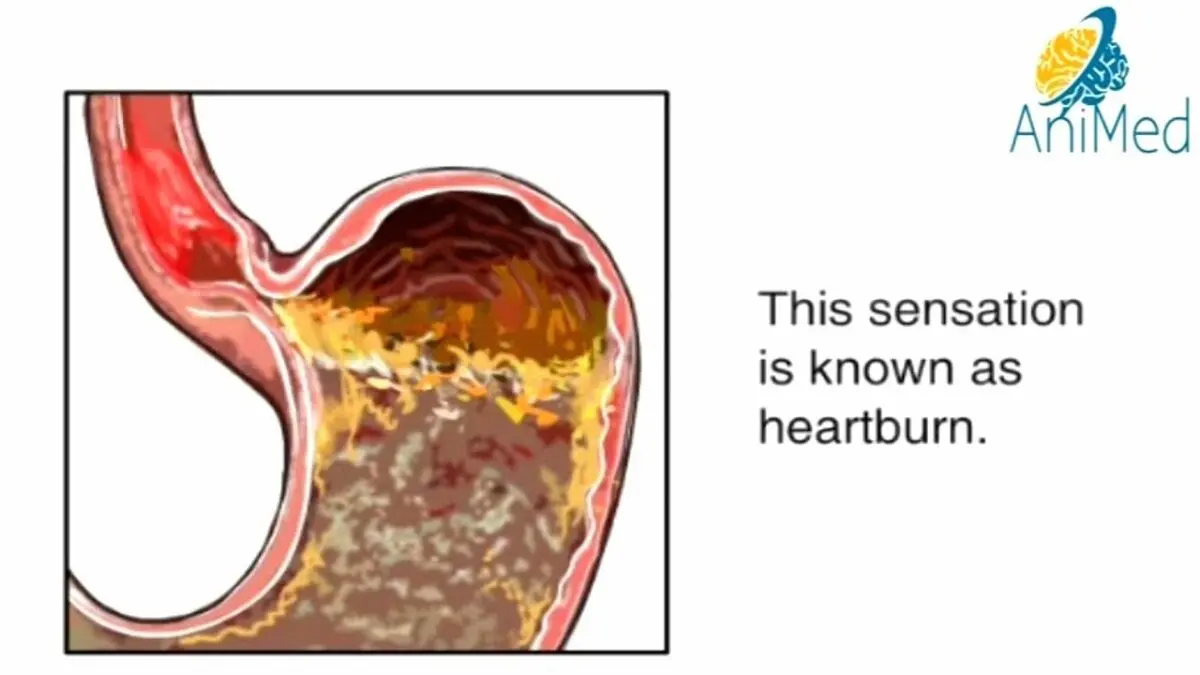 Heartburn: causes and prevention. Video