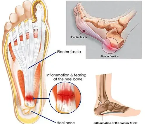 Heel pain: how to treat a heel spur? Video