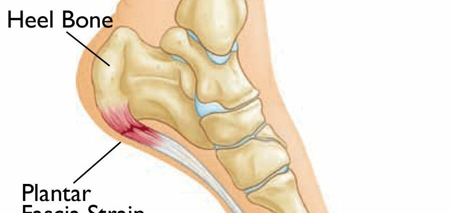 Heel pain: what is heel pain?