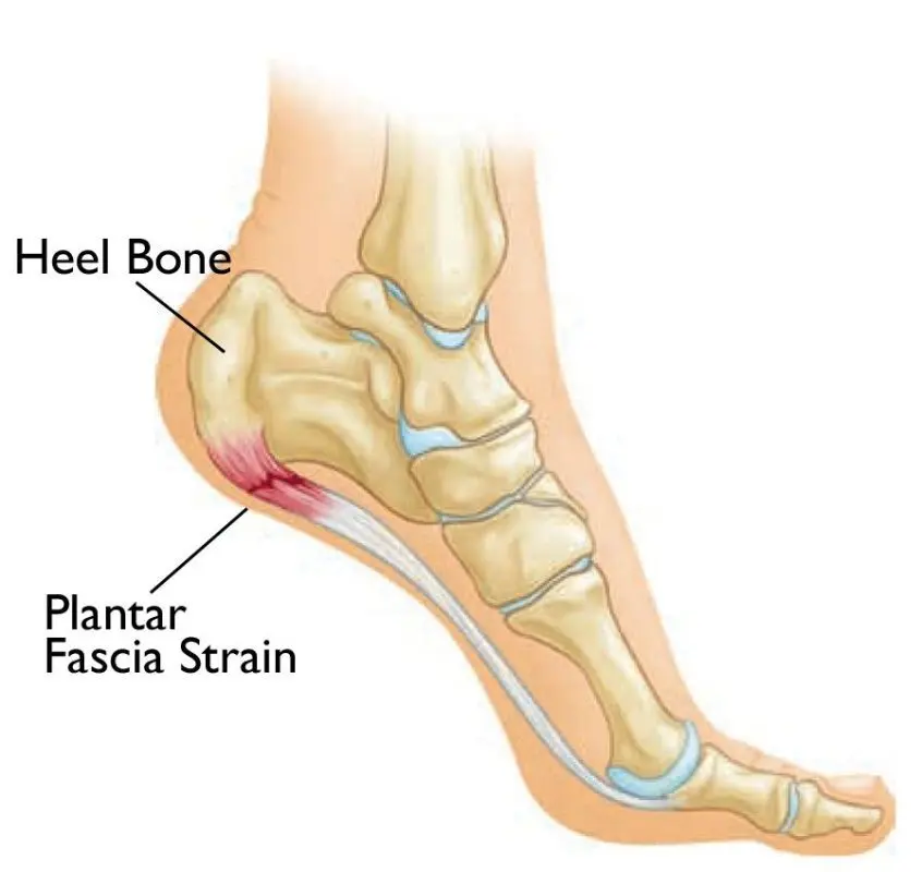 Heel pain: what is heel pain?