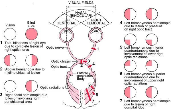 Hemianopsia: Definition, Causes, Solutions