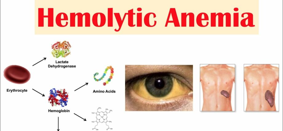Anemia hemolytic