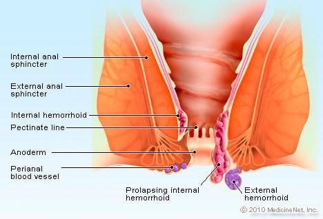 Hemorroides: recoñecen as hemorroides internas ou externas