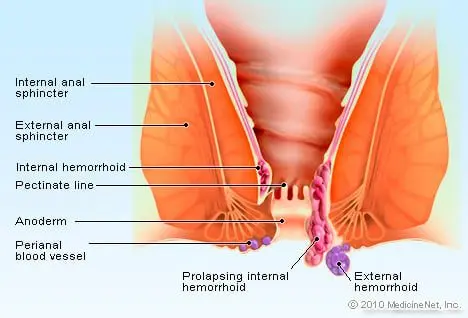 Hemorrhoids: recognize internal or external hemorrhoids