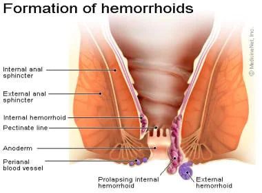 Hemorrhoids - Suíomhanna spéise