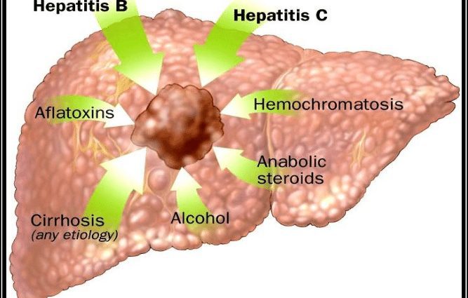 I-hepatocellular carcinoma