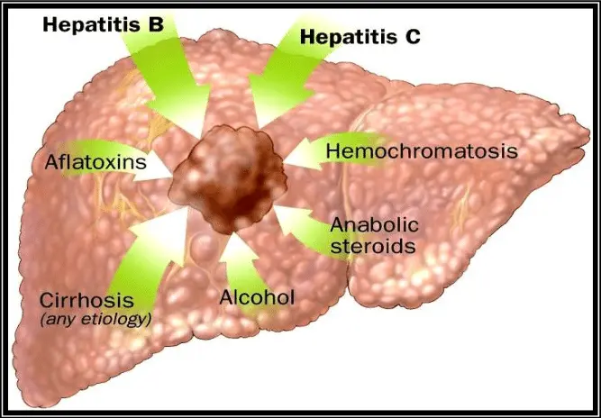 Hepatocellular carcinoma