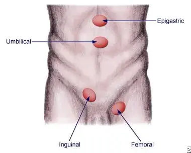 Hernia de mirror