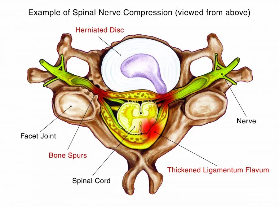 Herniated disc &#8211; Our doctor&#8217;s opinion