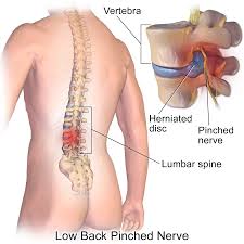 Herniated disc &#8211; Sites of interest