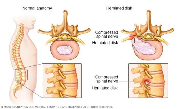 Herniated disc
