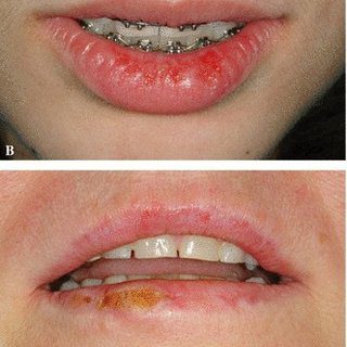 Herpes labialis &#8211; Complementary approaches