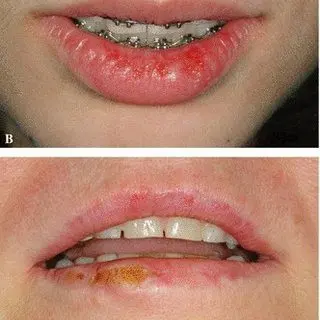 Herpes labialis &#8211; References and sites of interest