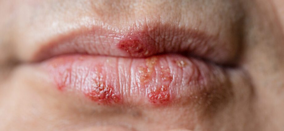 Herpes on the lips (cold sores on the lips)