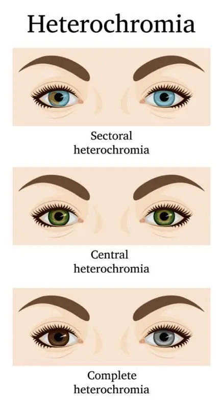 Heterochromia