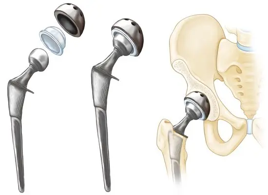 Hip prosthesis