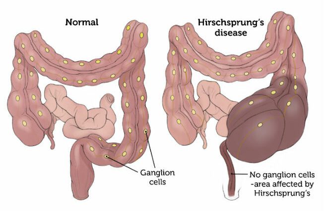 Hirschsprung disease