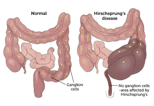 Hirschsprung disease