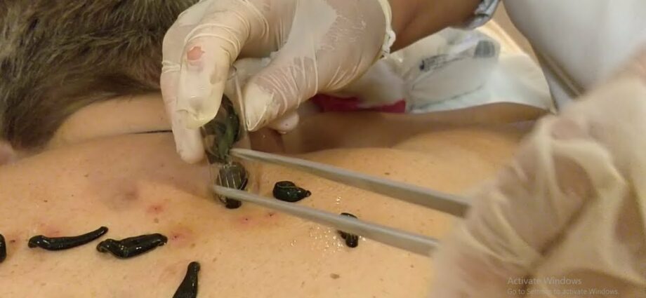 Hirudotherapy (treatment with leeches). Video reviews