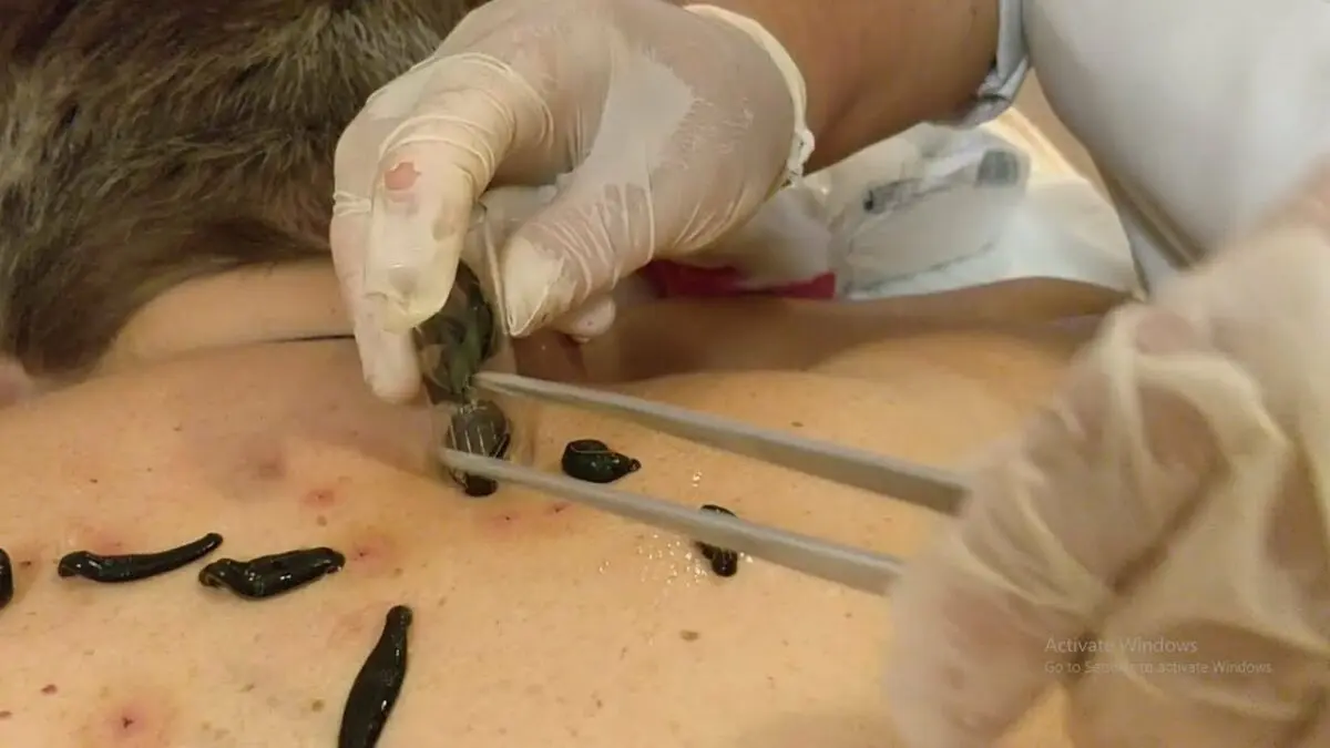 Hirudotherapy (treatment with leeches). Video reviews