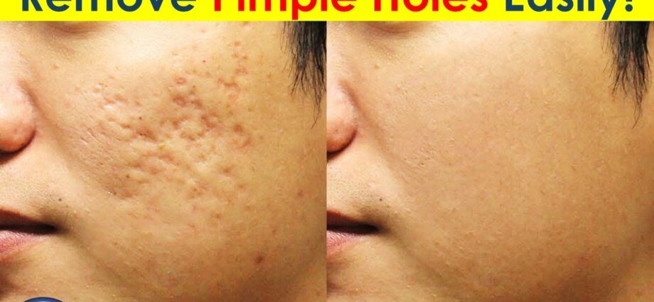 Holes on the face after acne: how to get rid of? Video