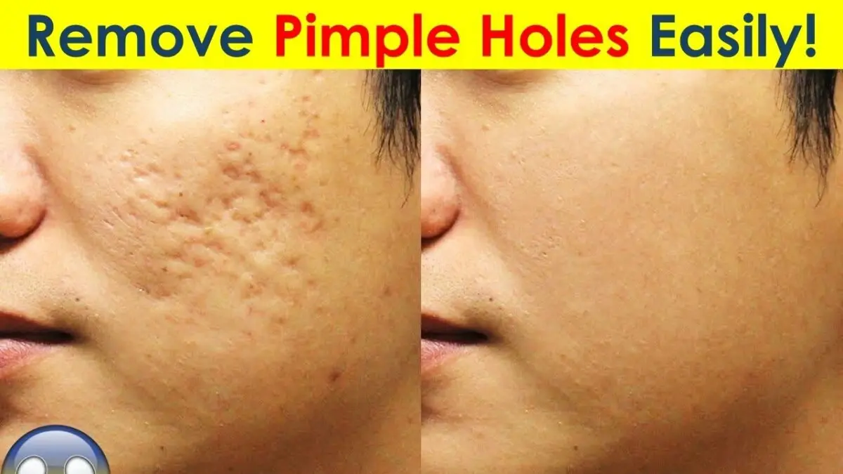 Holes on the face after acne: how to get rid of? Video