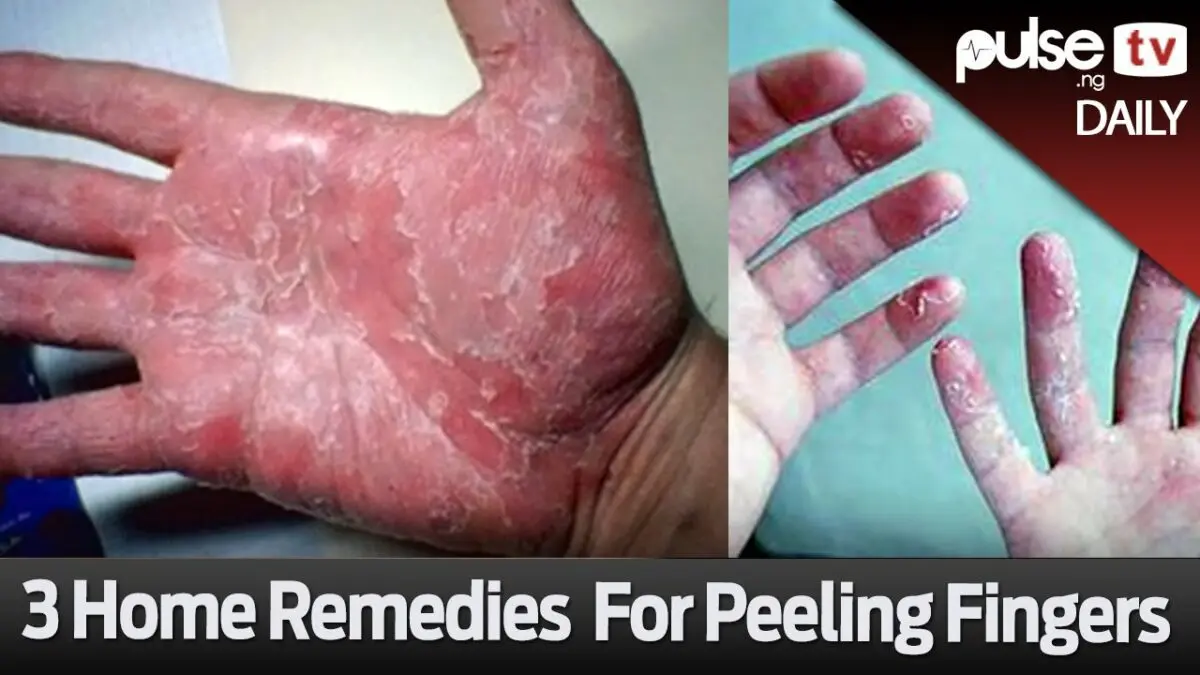 Home remedies for hand peeling. Video