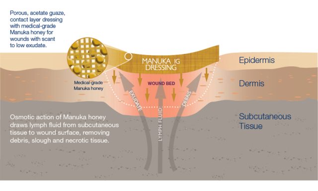 Honey to heal a wound: how to use it?