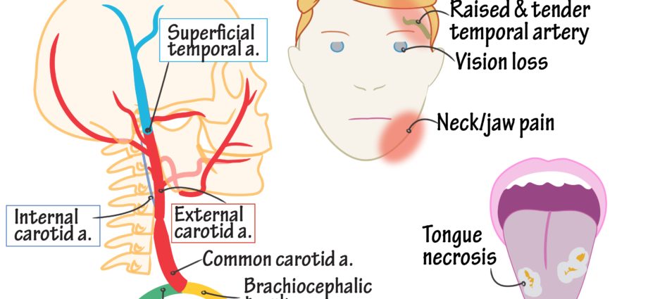 How is Horton&#8217;s disease diagnosed?