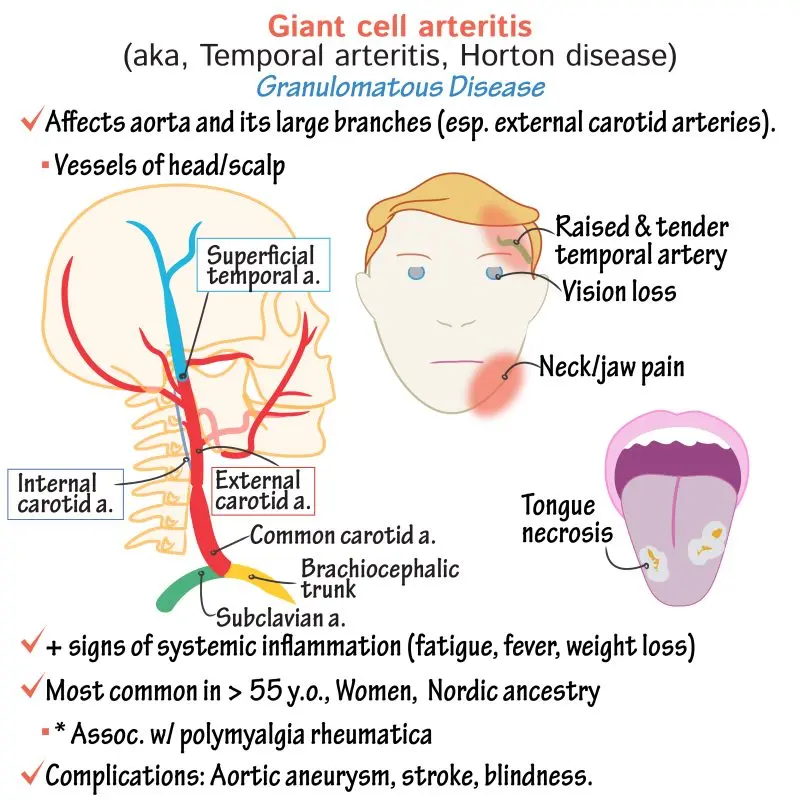 How is Horton&#8217;s disease diagnosed?