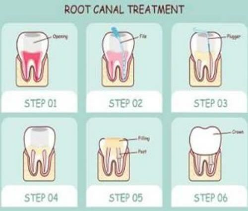 How long does a tooth hurt after extraction: how long does it take