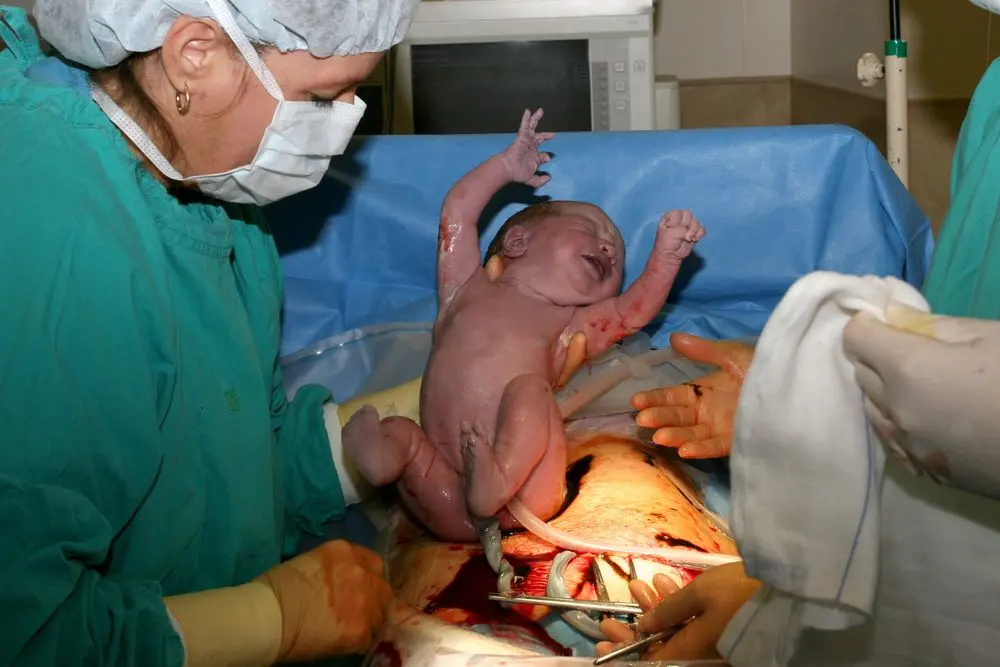 How long is the caesarean section done: planned, first, second, third