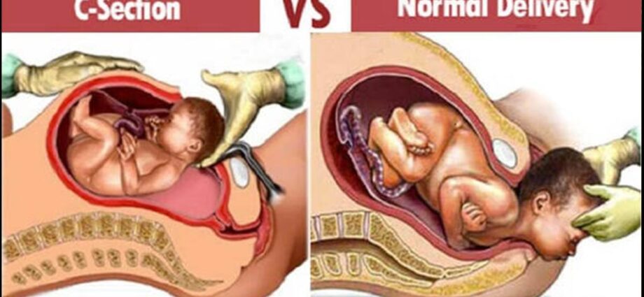 How the Caesareans differ from ordinary children