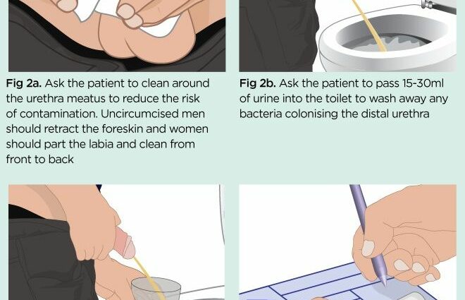 How to collect urine for analysis from an infant? Video