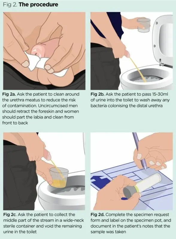 How to collect urine for analysis from an infant? Video