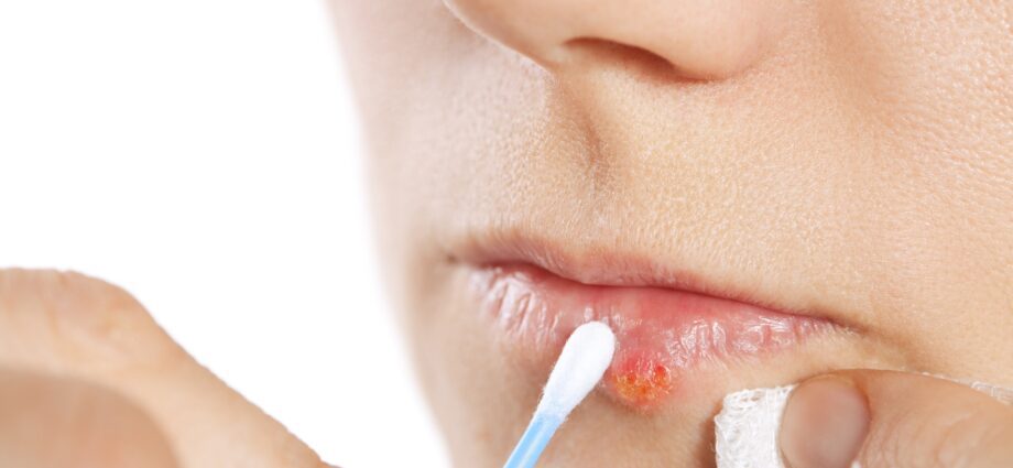 How to cure a cold sore lip (quickly cure sore lips)