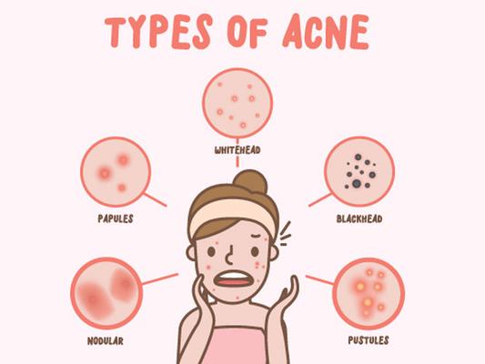 How to cure acne or what to do if you have acne