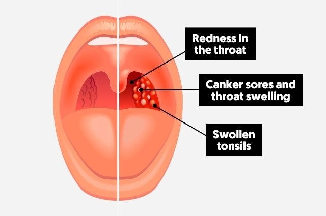 How to cure the throat of a nursing baby? Video