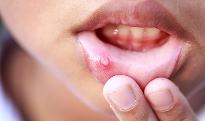 How to deal with stomatitis?