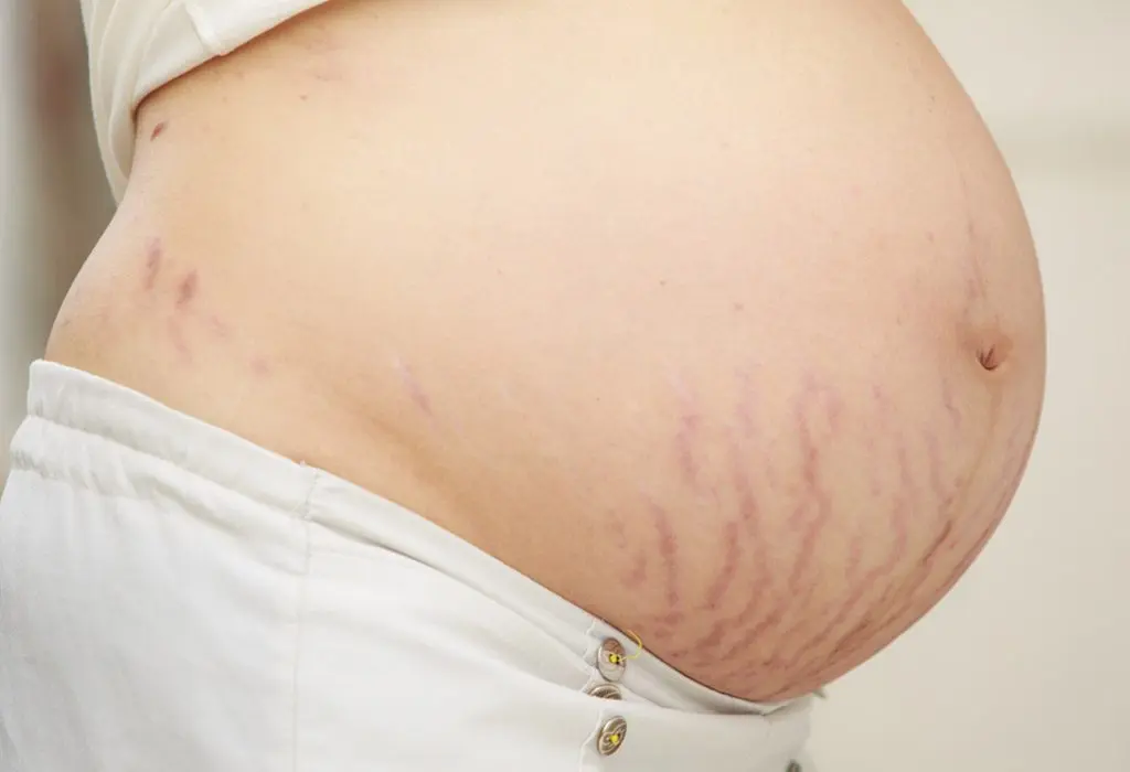 How to deal with stretch marks during pregnancy