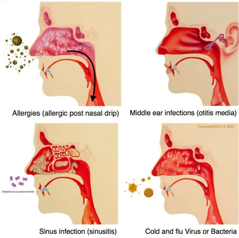 How to drip into the nose