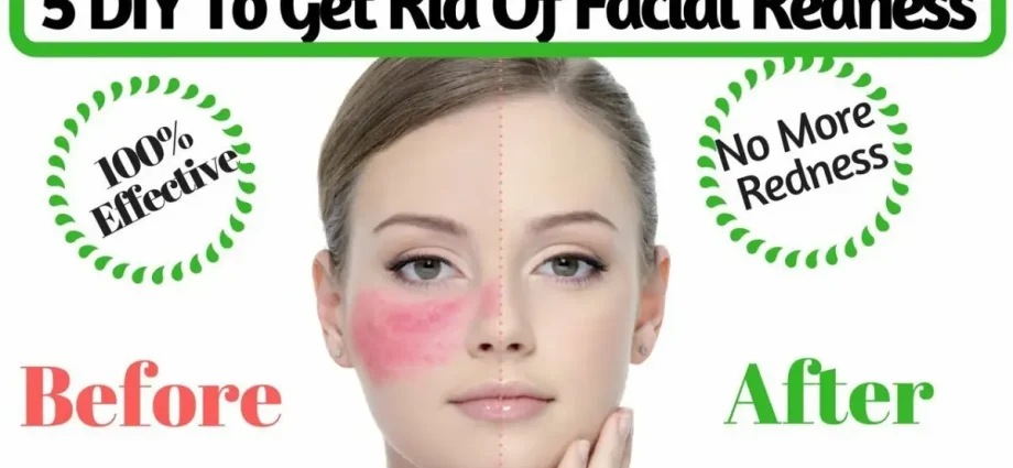 How to eliminate facial irritation. Video