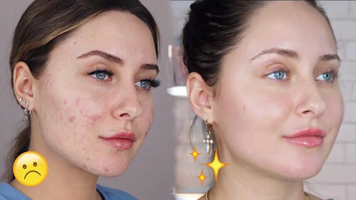 How to get rid of acne blemishes? Video