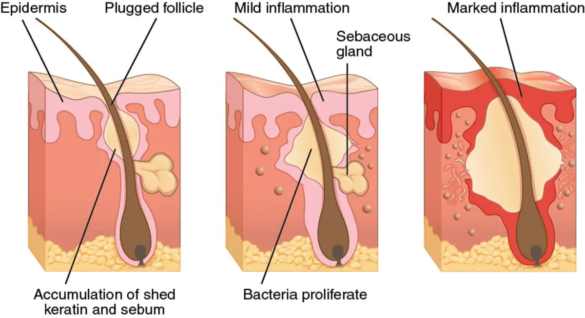 How to get rid of acne: step by step instructions