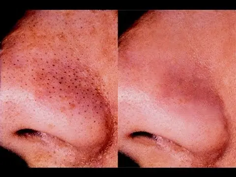 How To Get Rid Of Blackheads Once And For All: Dermatologist Tips