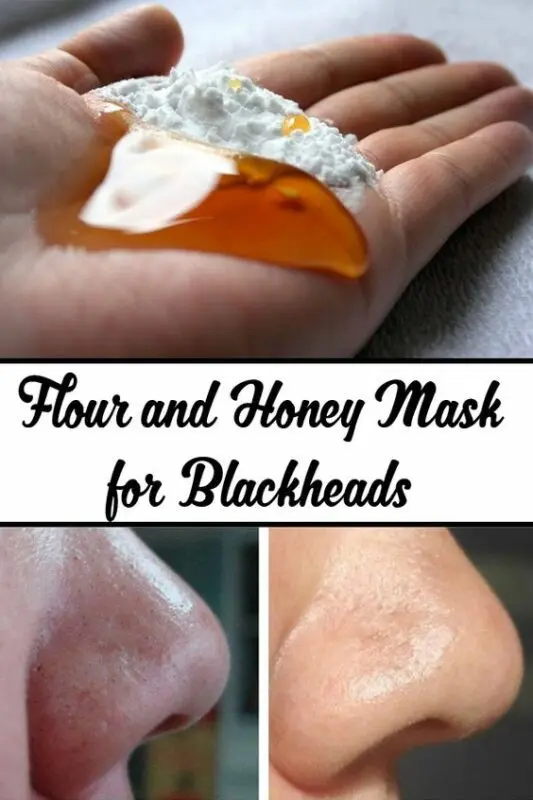 How to get rid of blackheads: quickly and permanently