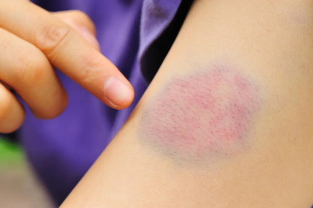 How to get rid of bruises. What remedies for bruises and bruises can be prepared at home