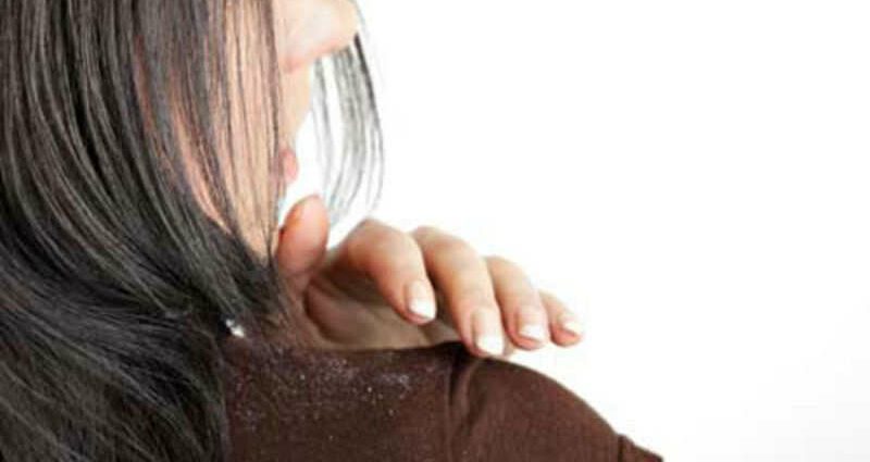 How to get rid of dandruff? 30 ways: fast, simple, effective and permanent